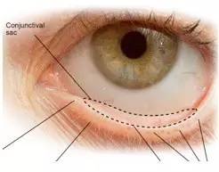 點眼藥水的正確步驟和姿勢 點眼藥水的正確步驟和姿勢