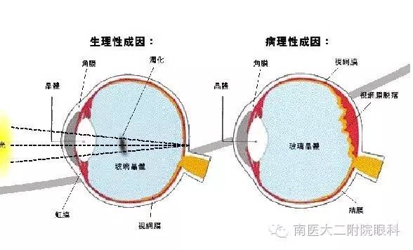警惕，近視眼更容易得飛蚊癥