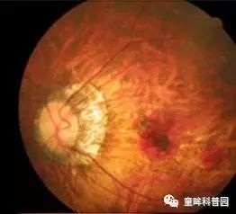 你不得不知的兒童近視幾大問(wèn)題