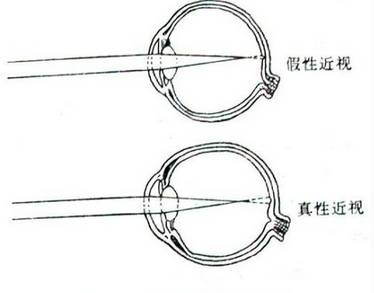 如何辨別真性近視和假性近視？