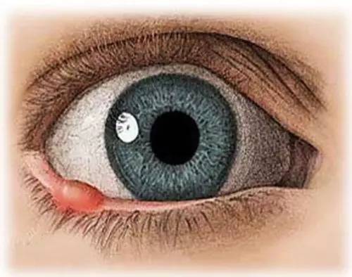 孩子長針眼怎么辦？