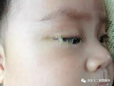 兒童眼病常見癥狀，你了解多少？