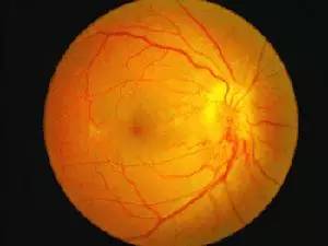 如何預(yù)防糖尿病視網(wǎng)膜病變 如何預(yù)防糖尿病視網(wǎng)膜病變