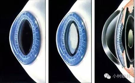 高度近視會遺傳寶寶嗎? 高度近視會遺傳寶寶嗎?