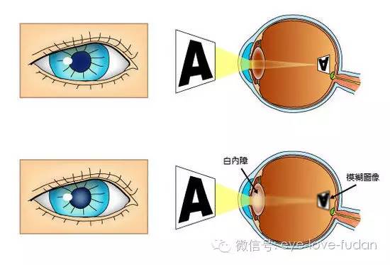 別指望眼藥水，白內障需要手術治療