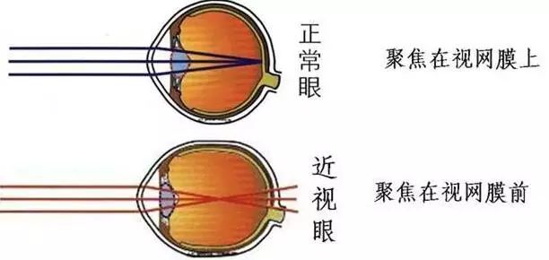 瞇眼睛真的能看的更清楚嗎？