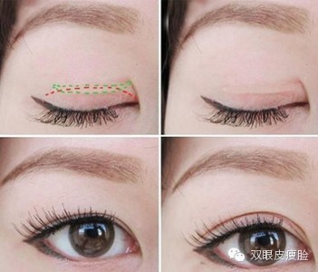 雙眼皮術前術后的注意事項 雙眼皮術前術后的注意事項
