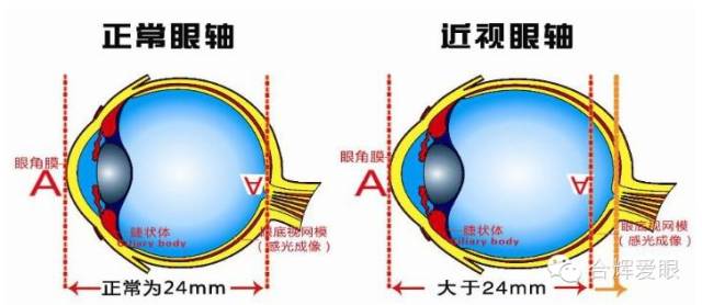 眼鏡戴久了,眼睛會變形嗎? 眼鏡戴久了,眼睛會變形嗎?