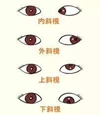 詳解近視、散光、遠(yuǎn)視、斜視及弱視 詳解近視、散光、遠(yuǎn)視、斜視及弱視