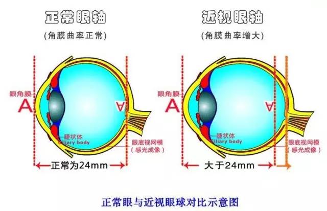 孩子近視度數(shù)猛漲？近視防控小心誤區(qū)！