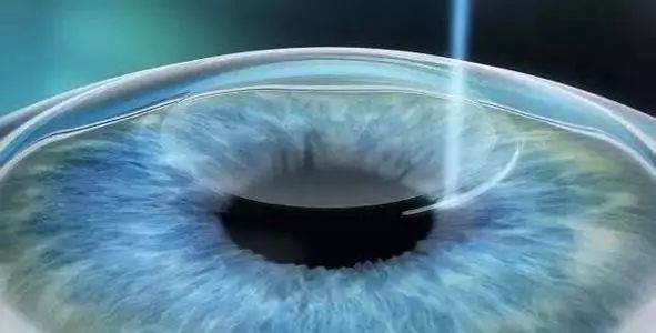 近視手術(shù)安全嗎？