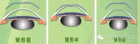 孩子度數持續增長怎么辦? 孩子度數持續增長怎么辦?