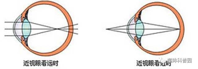 你不得不知的兒童近視幾大問(wèn)題