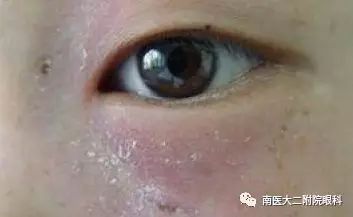 淚道阻塞的癥狀和危害有哪些？