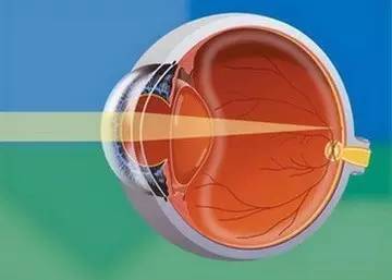 眼睛為什么會散光? 眼睛為什么會散光?