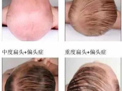 雙眼皮術(shù)前術(shù)后的注意事項(xiàng)