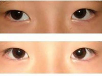 孩子眼睛模糊，就是近視？