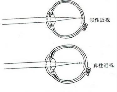 如何辨別真性近視和假性近視？
