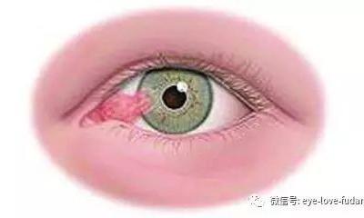 人眼為什么會長“多肉”？