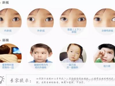 孩子斜弱視治療，不要錯過關鍵時機