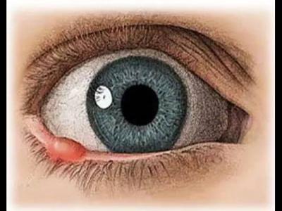 孩子長(zhǎng)針眼怎么辦？