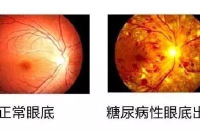 糖尿病會導(dǎo)致眼睛失明，視力模糊是前期征兆！