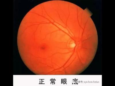 什么度數(shù)一直增加？戴鏡度數(shù)加深的五大原因！