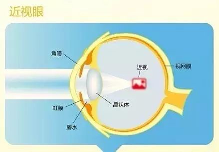 近視的原因、預(yù)防與治療