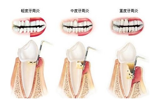 為什么會(huì)有牙周病？牙周病的中醫(yī)治療和保養(yǎng)方法