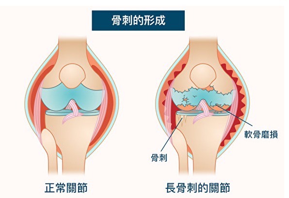 長骨刺有哪些原因？從中醫角度來看骨刺的預防與緩解方法