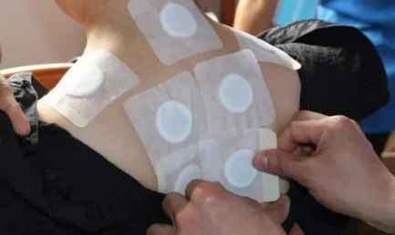 三伏貼必須入伏當(dāng)天貼嗎