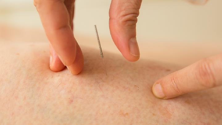 中醫針灸常見的4種好處須知 這7類人針灸需注意