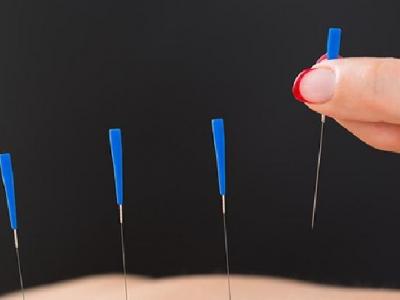 蕁麻疹的針灸治療方法有哪些 中醫(yī)治療蕁麻疹的6種針灸方法