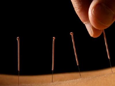 中醫針灸怎么治療前列腺炎 中醫針灸治療前列腺炎的幾種方法