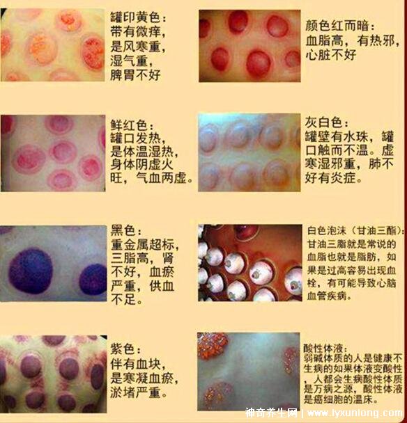 拔罐顏色癥狀對照表圖解，深淺代表不同病癥(越淺越好)