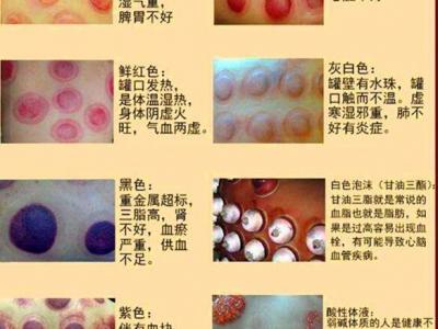 拔罐顏色癥狀對(duì)照表圖解，深淺代表不同病癥(越淺越好)