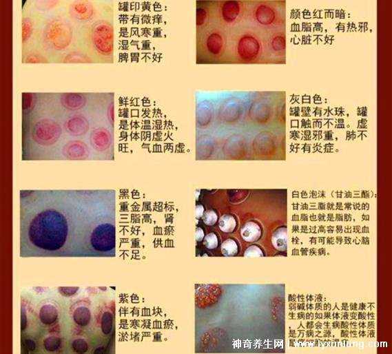 拔罐顏色癥狀對(duì)照表，紅色/黃色/藍(lán)色代表各不同(顏色深淺圖解)
