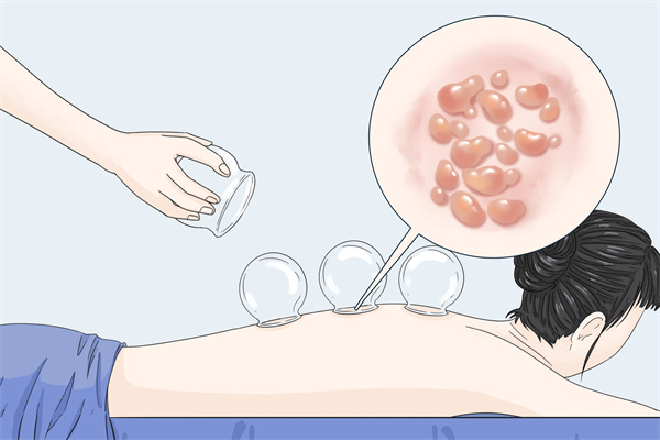 拔罐后可以吹空調(diào)嗎