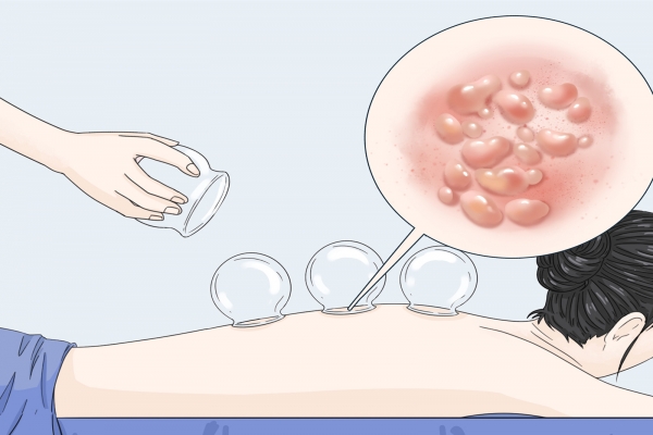 拔罐多久可以吹空調(diào)-易網(wǎng)<a href=http://www.gyfww.com/ target=_blank class=infotextkey>健康養(yǎng)生</a>網(wǎng) 拔罐多久可以吹空調(diào)