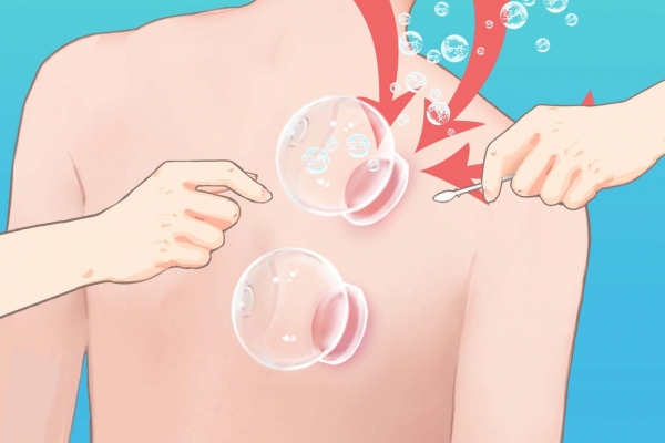 拔火罐有什么好處